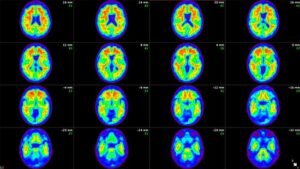 Imagen cerebral Alzheimer placas beta amiloide Donanemab tratamiento en Perú